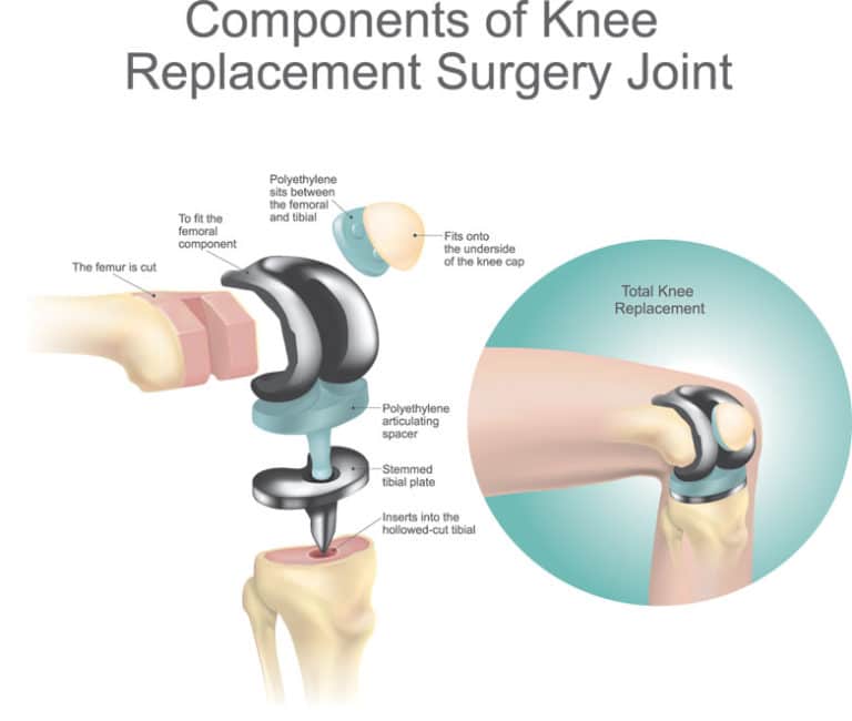 Knee Replacement Surgery (Total Knee Arthroplasty)