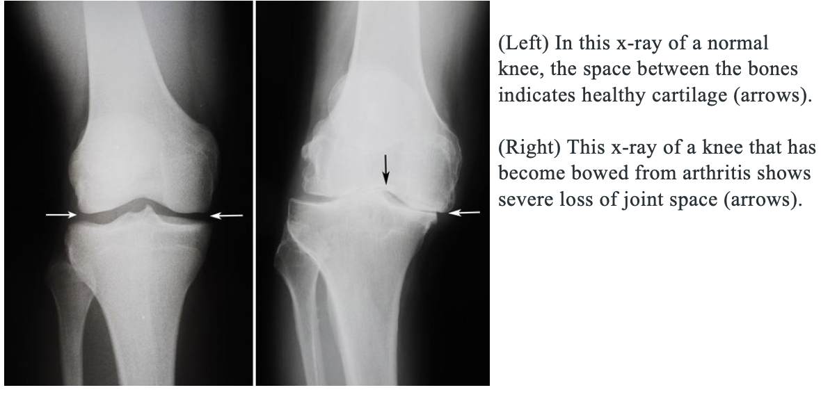 Knee Replacement  Thomas Baier M.D.