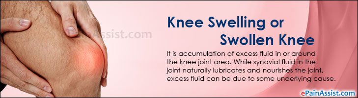 Knee Swelling or Swollen Knee