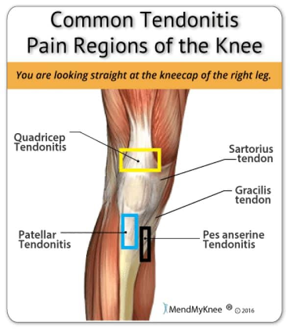 Knee Tendonitis Anatomy. Common areas of the knee that are afflicted ...