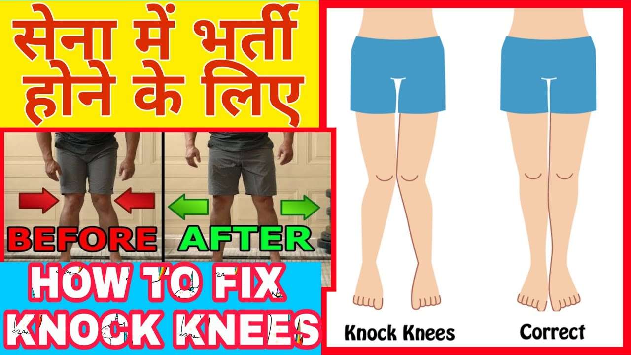 Knock Knees Exercise à¥¤ Knock Knees kaise Thik Kare à¥¤ How To Fix Knock ...
