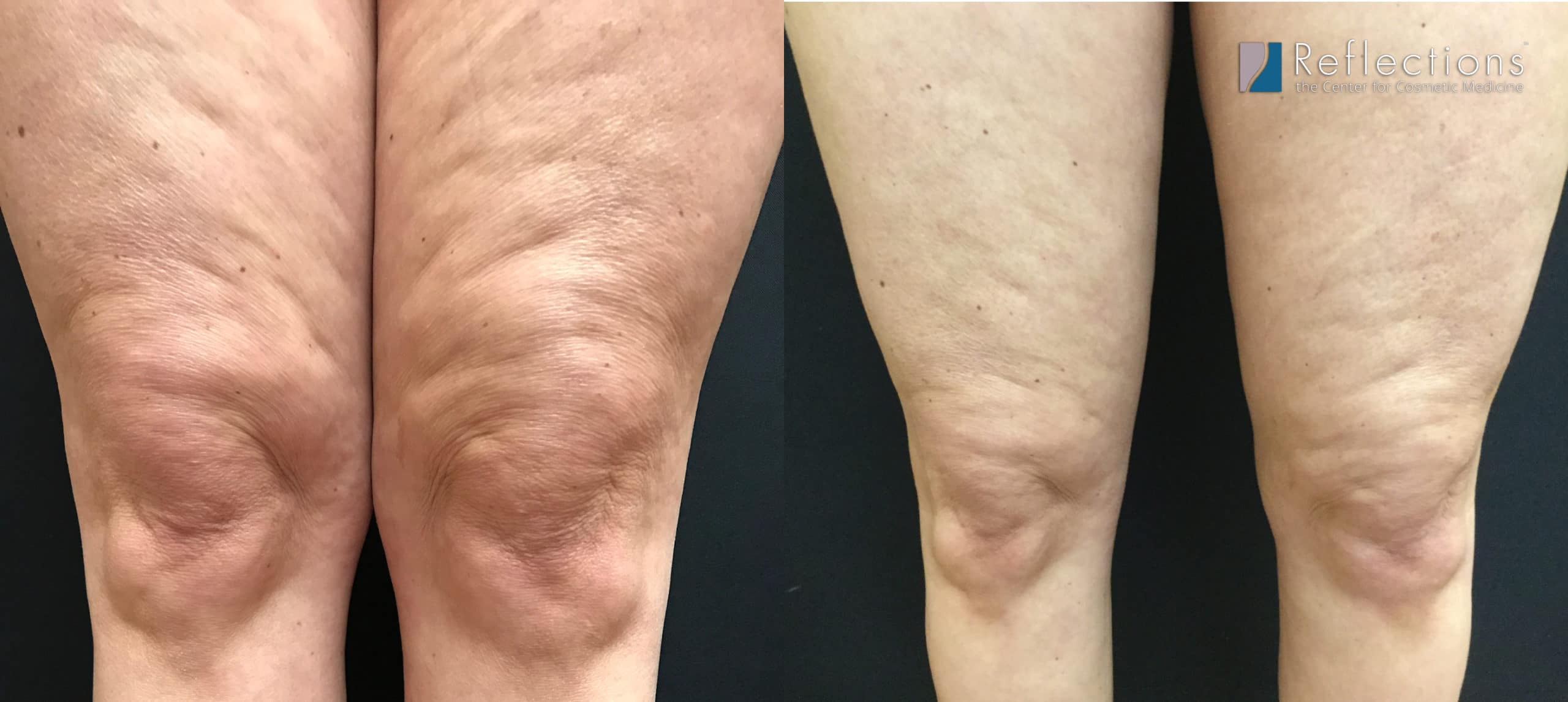 Laser Lipo for Knee Fat Plus Exilis for Thigh Skin Tightening Results ...