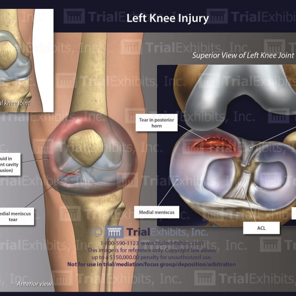Left knee Injury