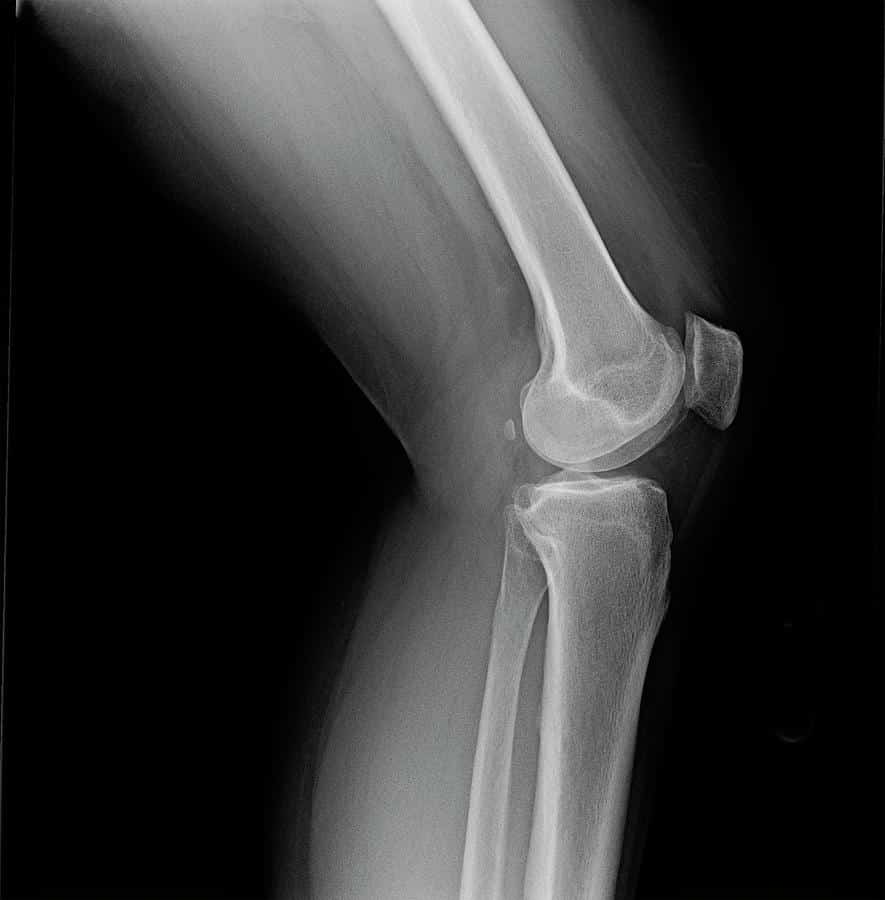 Left knee joint x
