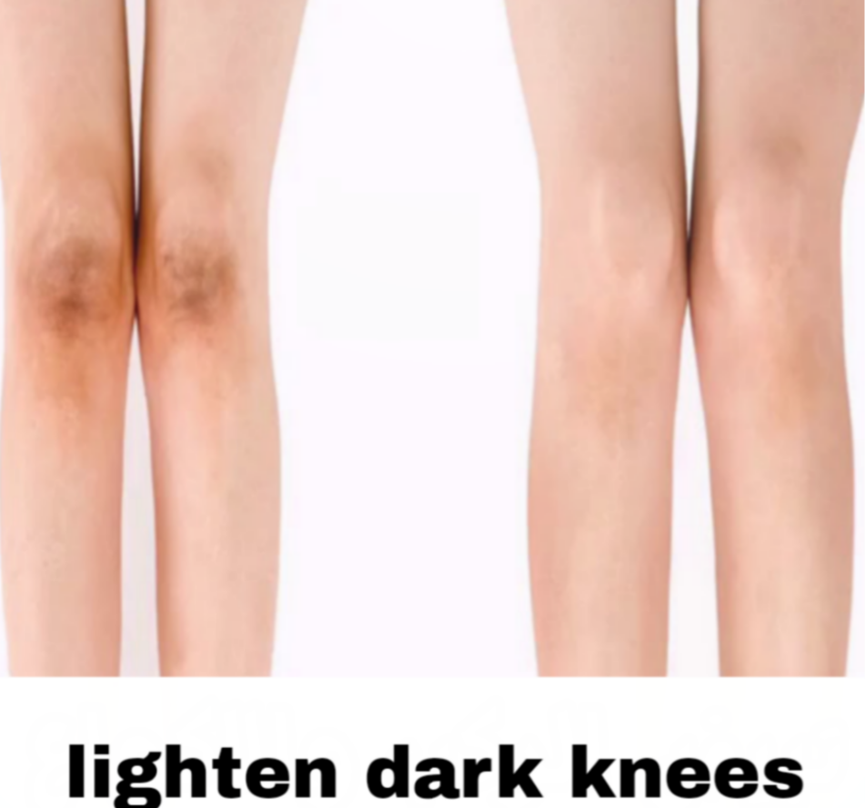 lighten dark knees in a few days by easy natural ways ...