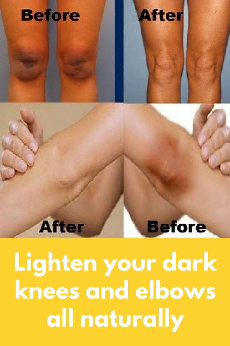 Lighten your dark knees and elbows all naturally Today I ...