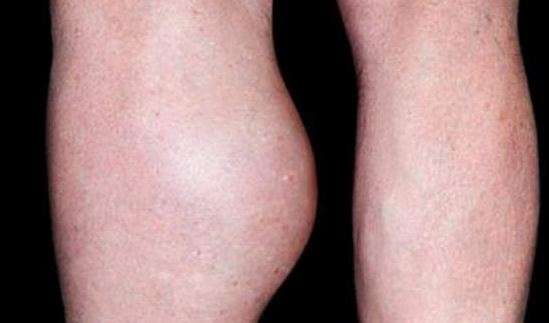 Lump behind Knee Bakers Cyst Causes, Symptoms, Images ...
