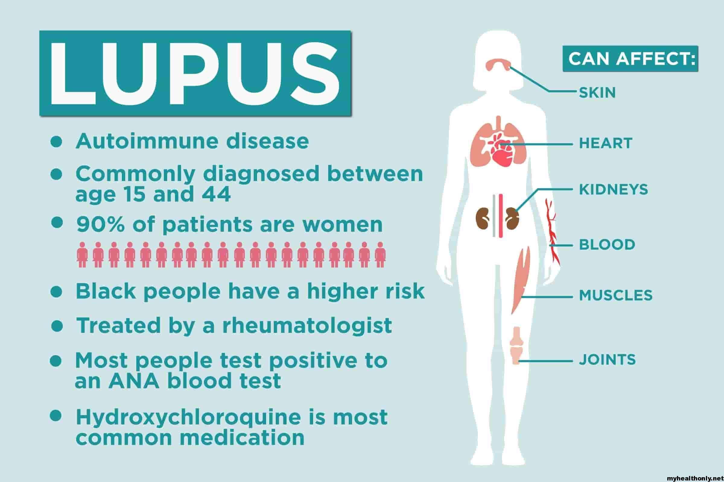 Lupus Symptoms, Causes, Diagnosis, Treatment &  Complications