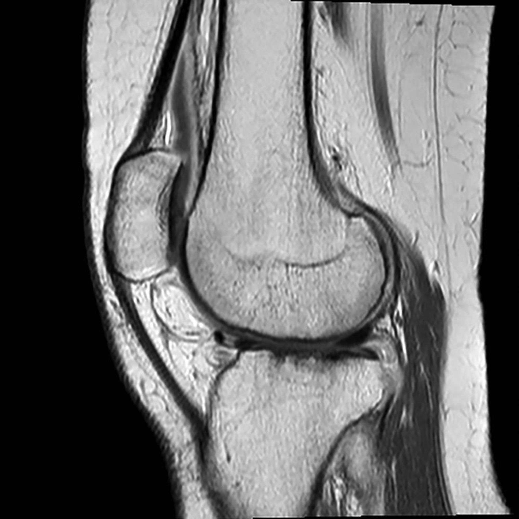 Magnetic Resonance Imaging (MRI) of the Knee as an Outcome Measure in ...