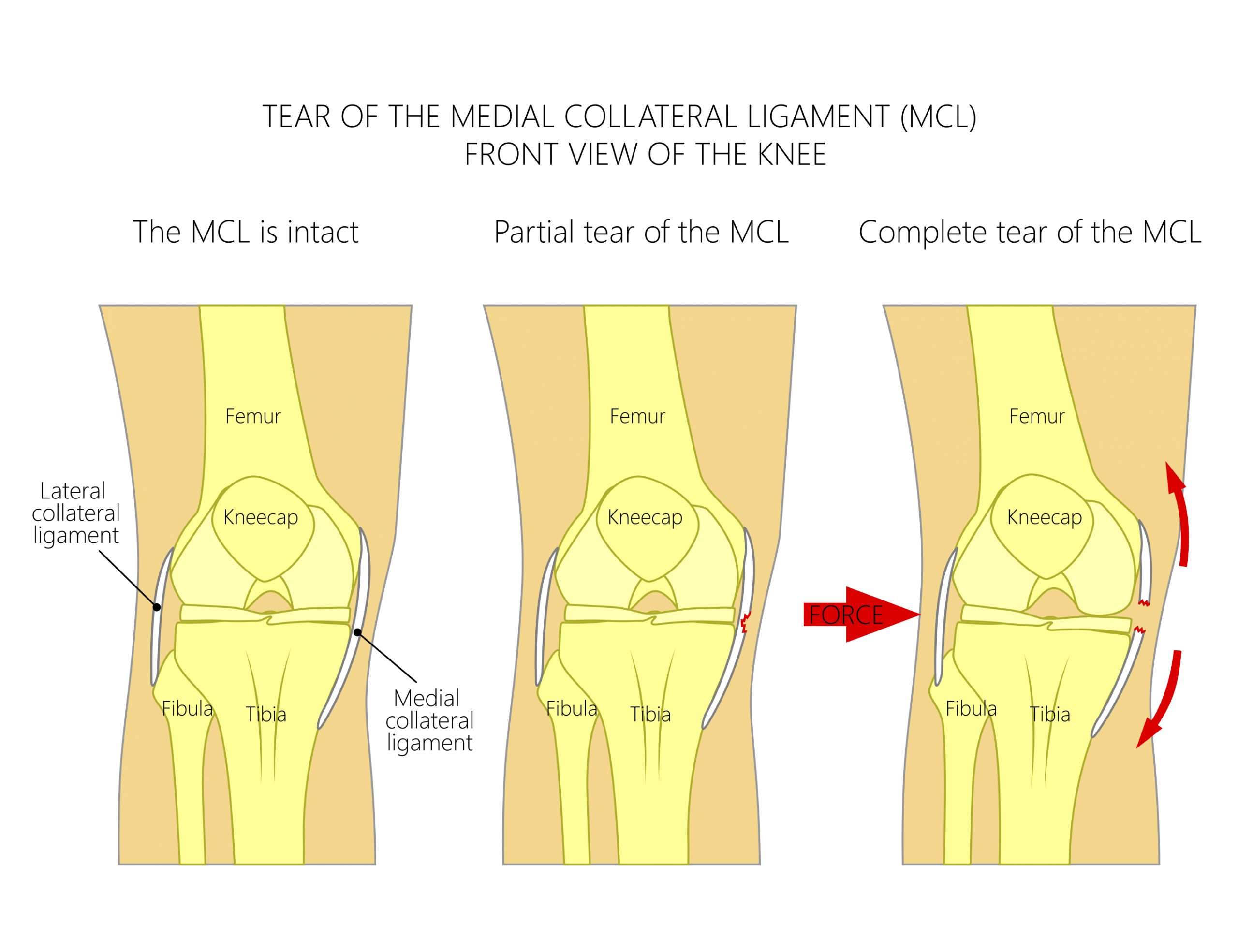 MCL Injury Treatment