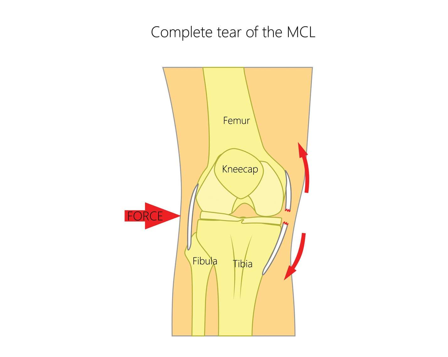 Medial Collateral Ligament (MCL) Tears