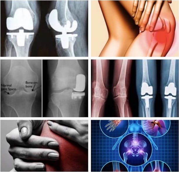 Medsolin  Affordable knee replacement