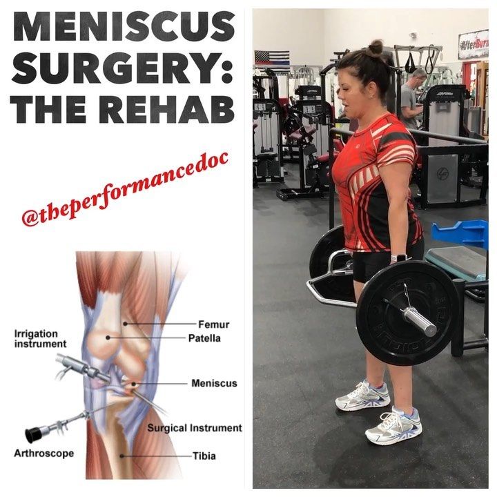 Meniscus Rehab Its amazing how well patients are doing following ...