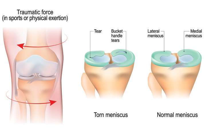 Meniscus Tear in Knee  Causes, Symptoms &  Treatment ...