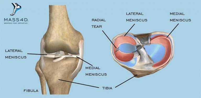 Meniscus tear treatment with 4 exercises to avoid surgery