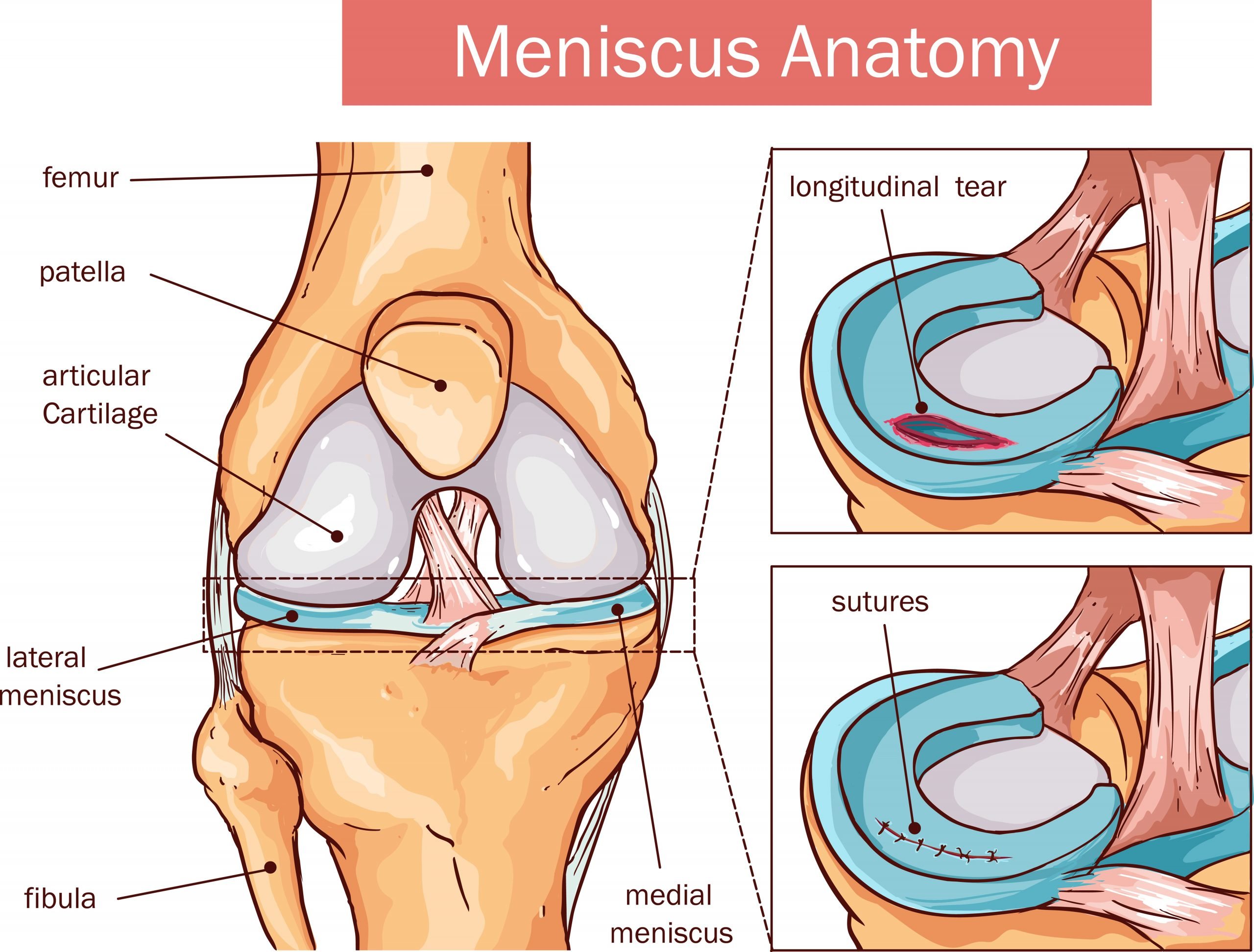 Meniscus vs. Cartilage Tear of the Knee
