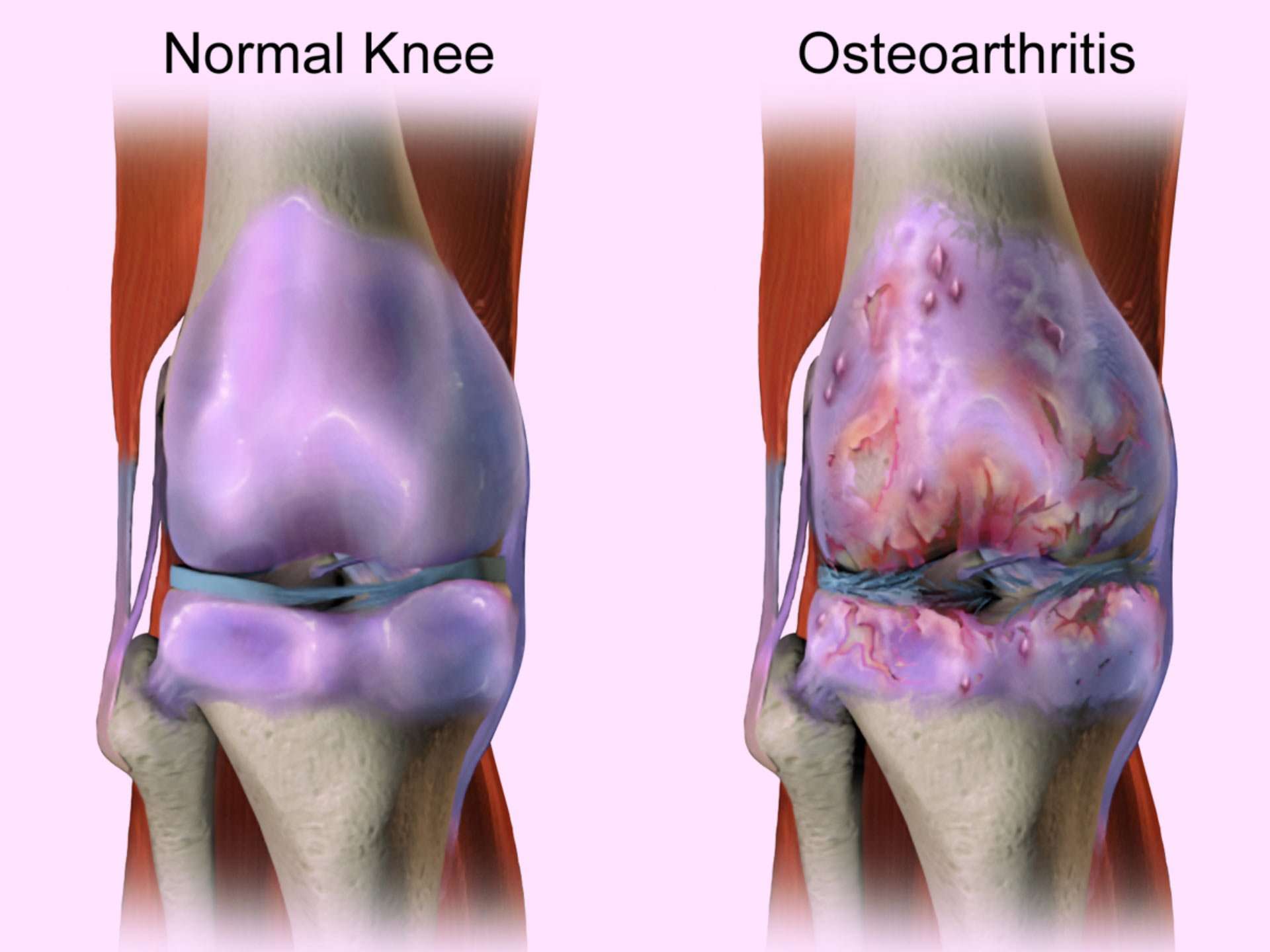 Menopausal Hormone Therapy Effective against Knee Osteoarthritis: Study ...