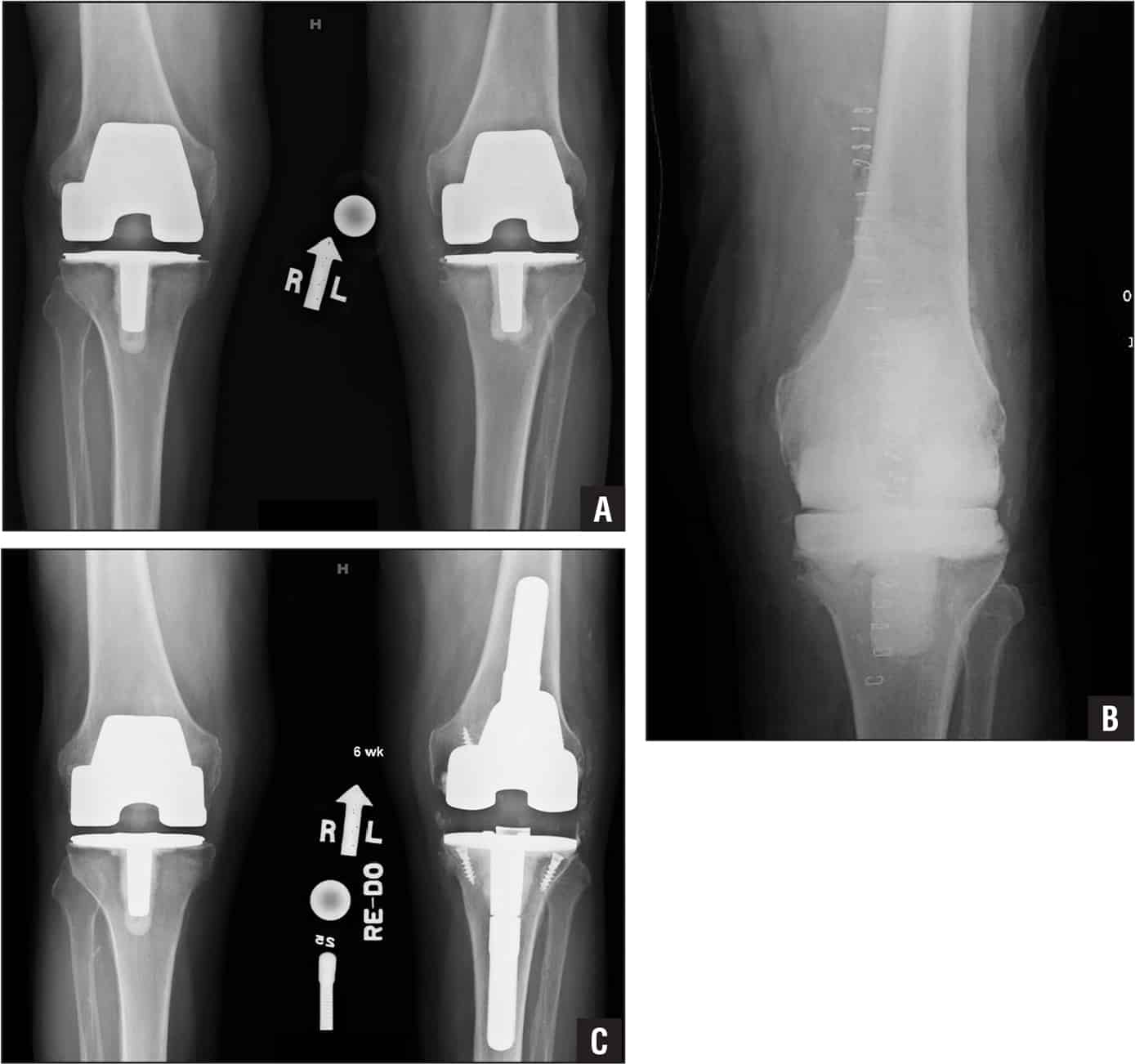 Midterm Results of the Vanguard SSK Revision Total Knee Arthroplasty System