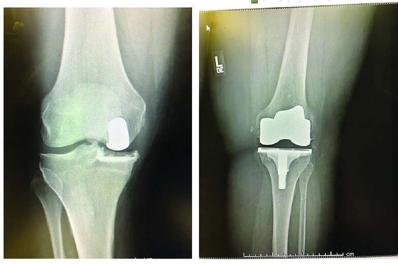 Minimally Invasive Partial Knee Replacement