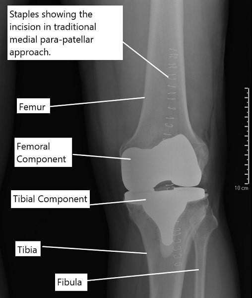 Minimally Invasive Vs Total Knee Replacement