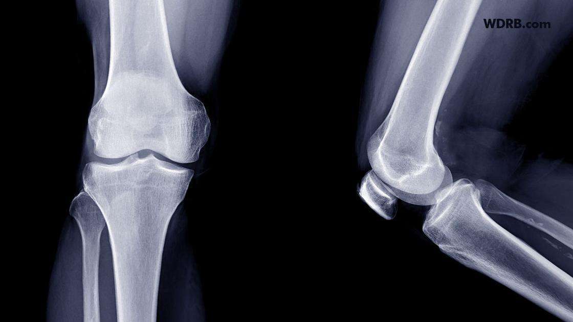 Most people wait too long for knee replacement surgery ...