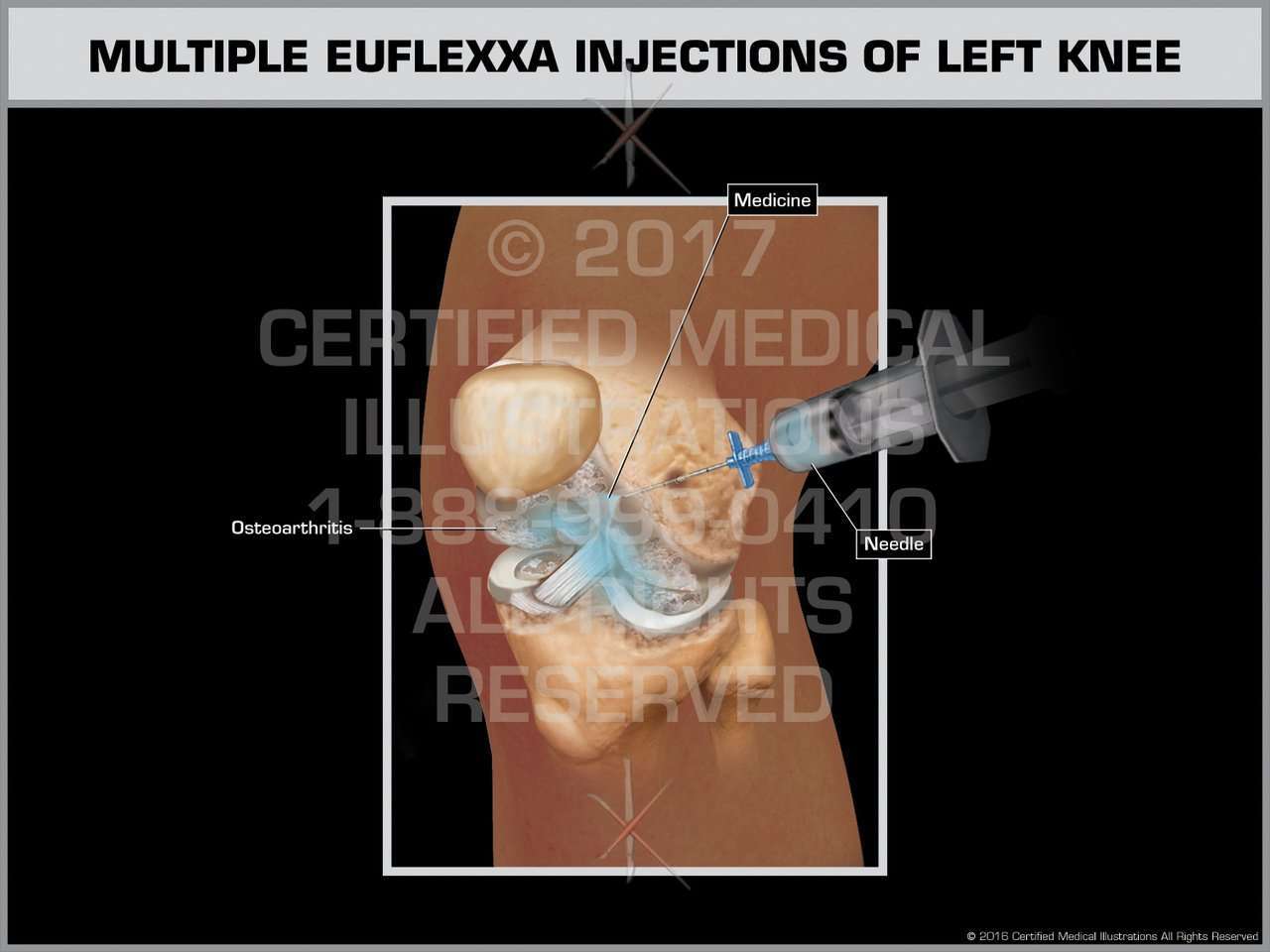 Multiple Euflexxa Injections of Left Knee