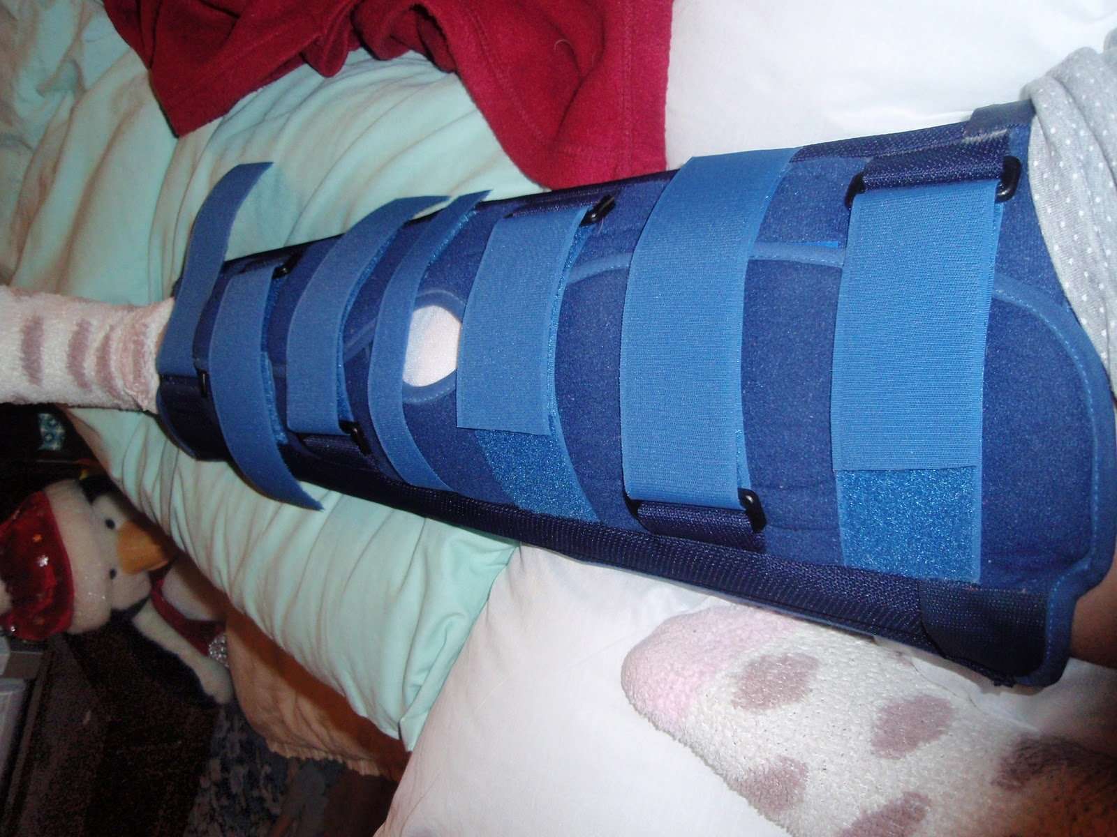 My Broken Knee Story: Getting Around in a Splint