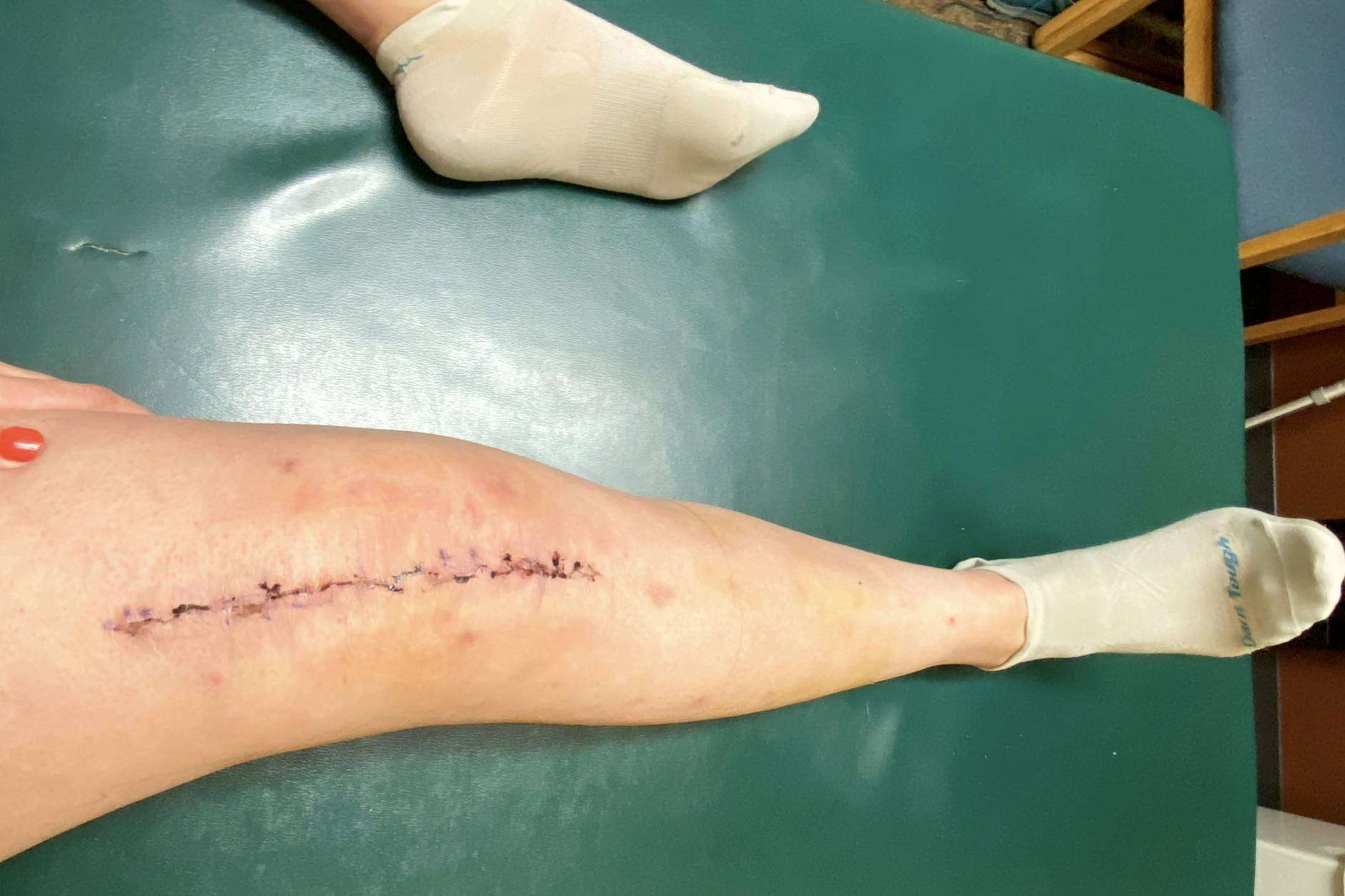 My First Knee Replacement at Age 35: How I Got Here ...