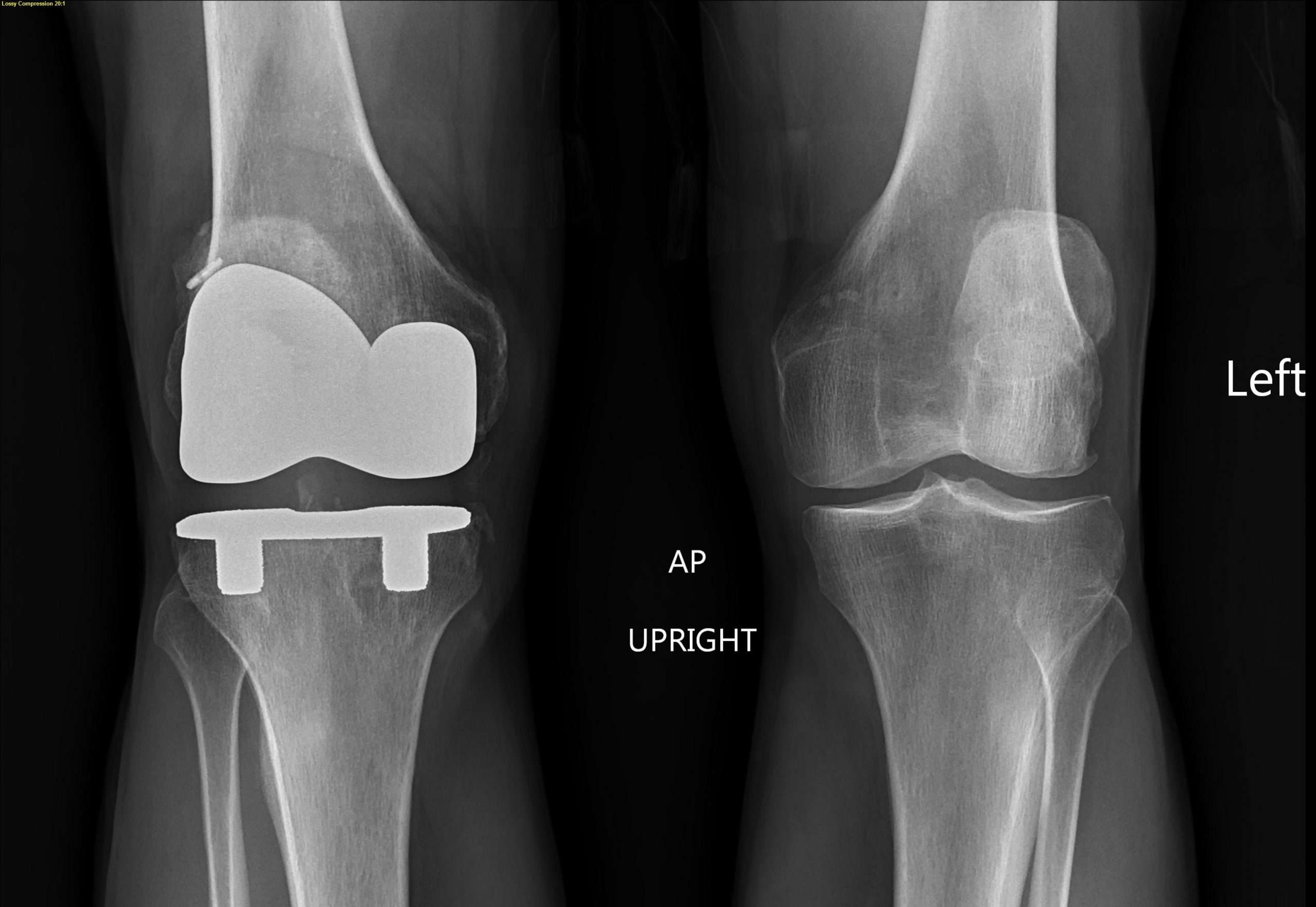 My New Knee: Running Again after a Total Knee Replacement â Uphill Athlete