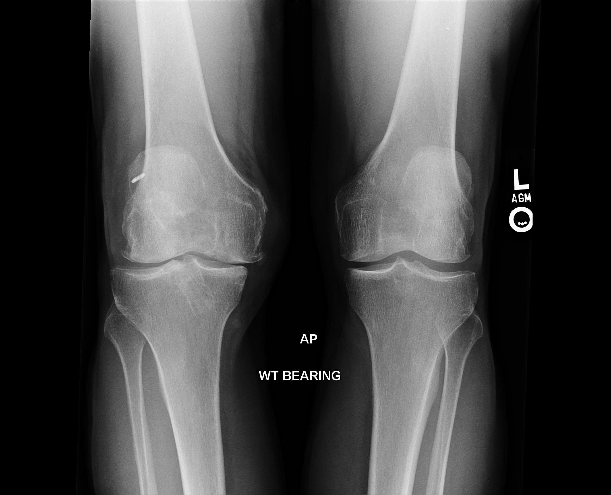 My New Knee: Running Again after a Total Knee Replacement ...
