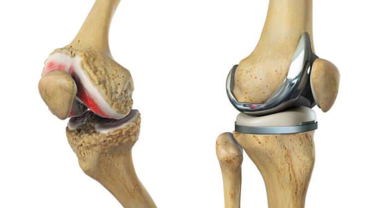 Myths and truth of knee replacement surgery explained in easy words