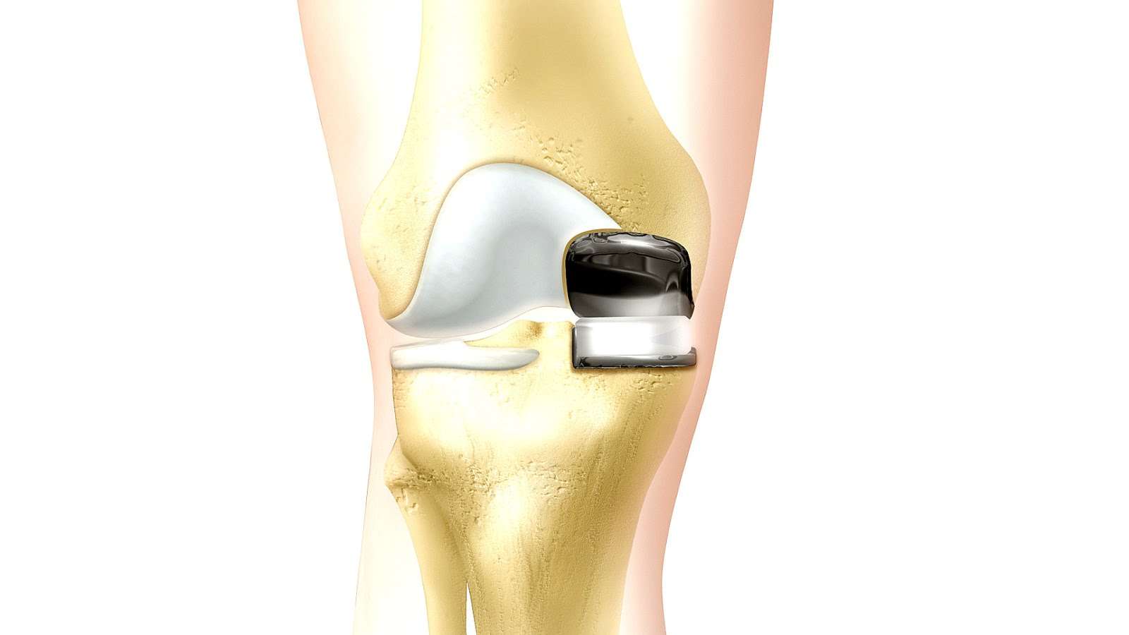 Natural Alternative To Knee Replacement Surgery