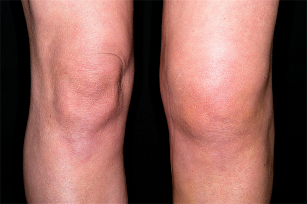 Natural and Medical Ways to Remove Knee Fluid
