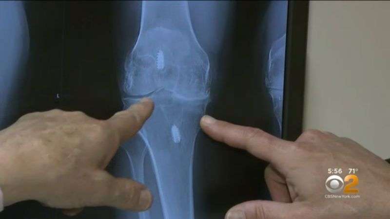 New Procedure Allows Total Knee Replacement Patients To Go ...