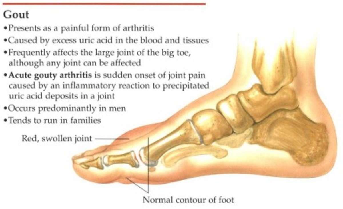 No More Gout Pain ! A Testimonial to Pain Relief from Gout ...