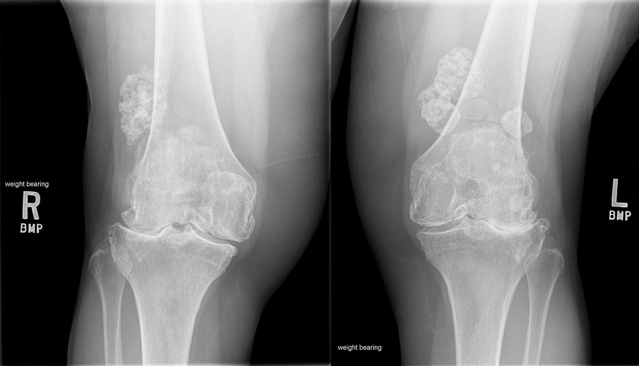 Not a typical case of bilateral knee osteoarthritis