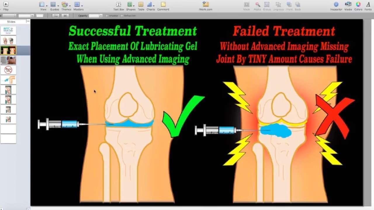 NYC Pain MD Knee Arthritis Gel Injections New York City ...