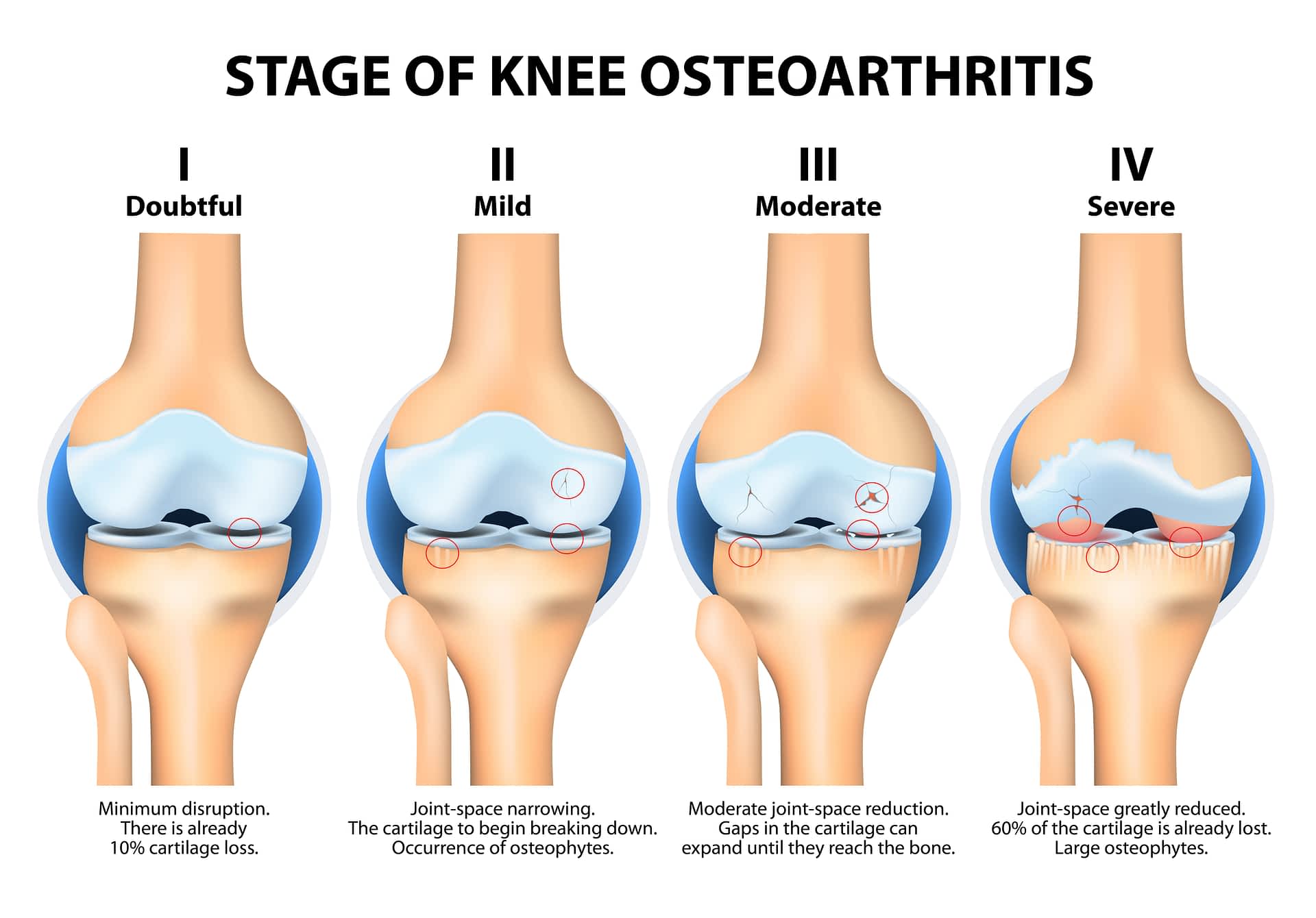Osteoarthritis in the Knee