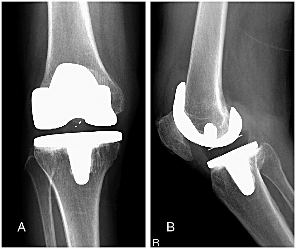 Osteoarthritis Knee with Patellar Fracture in the Elderly