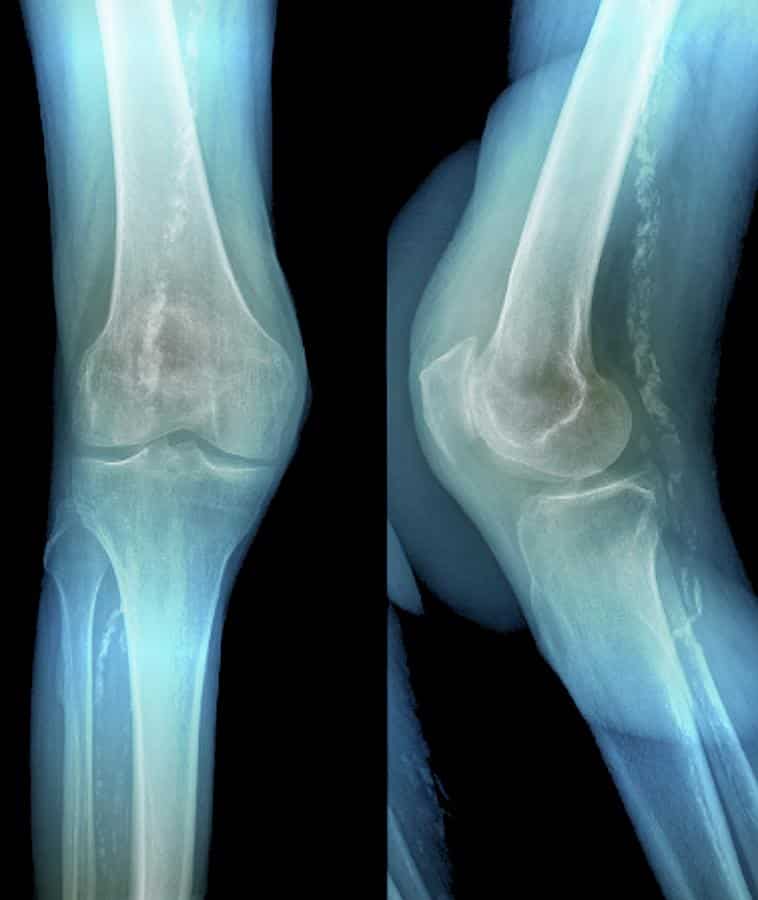 osteoarthritis of knee cap photograph by zephyrscience photo library