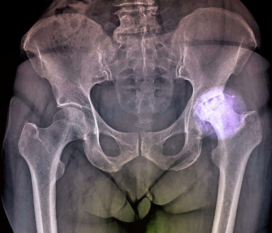 Osteoarthritis Of The Hip Photograph by Zephyr/science Photo Library ...