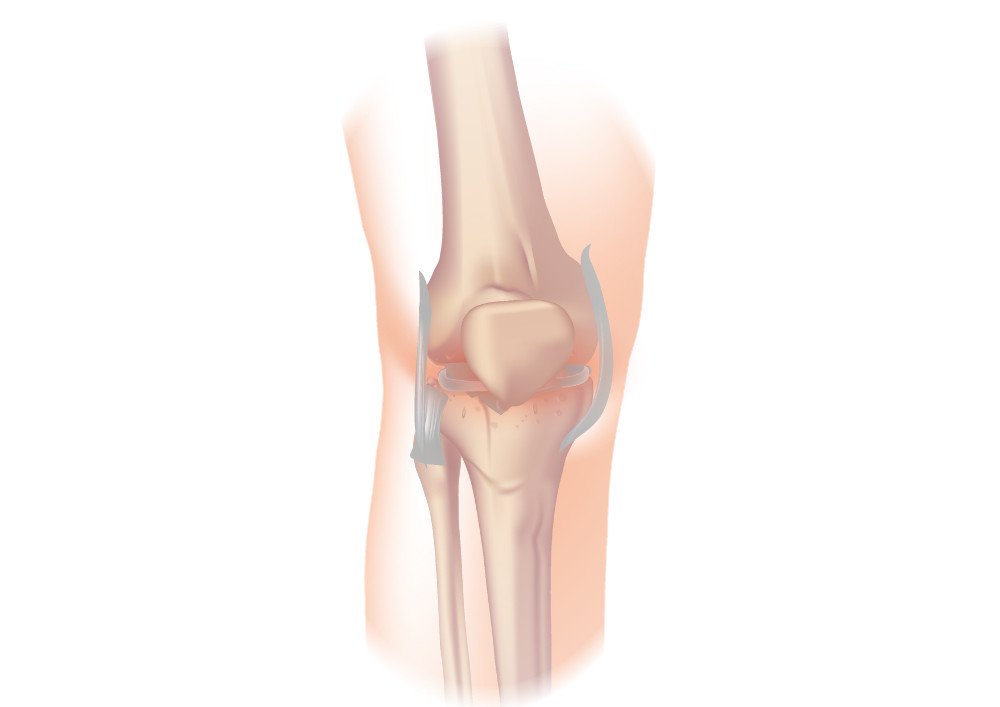 Osteoarthritis of the knee: causes, symptoms, exercises ...