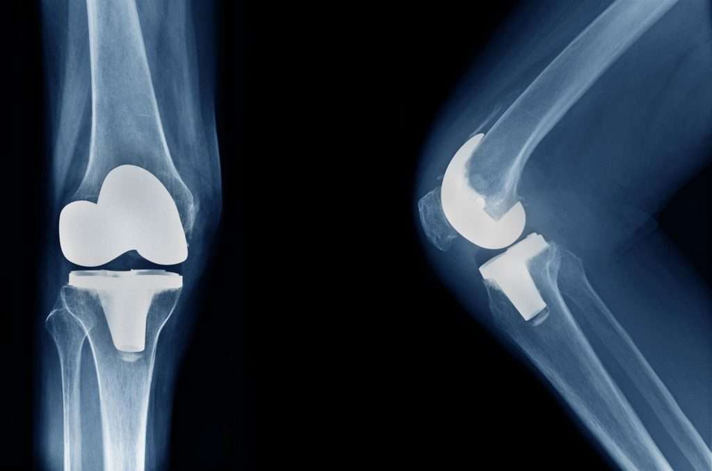 Outpatient knee replacement: The great debate