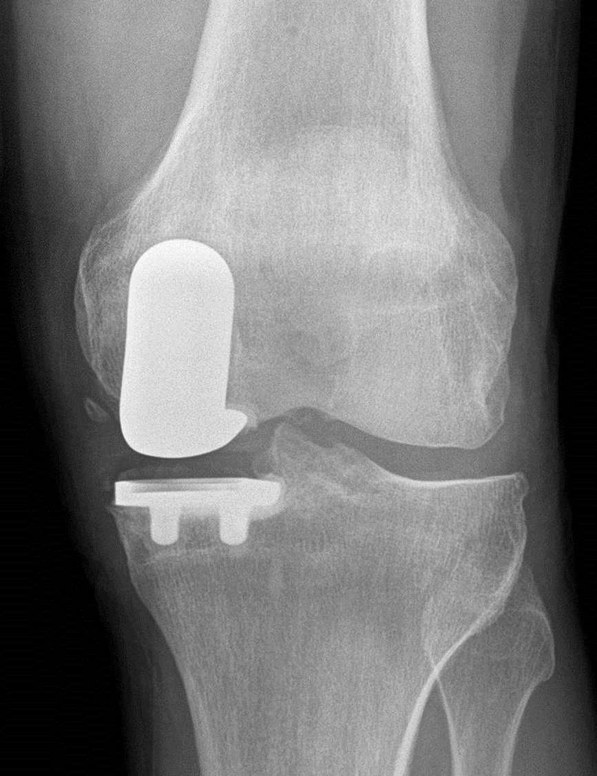 Outpatient Knee Replacement: The Great Debate