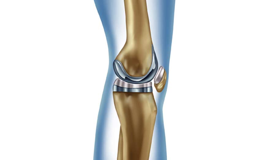 Outpatient Minimally Invasive Total Knee Replacement ...