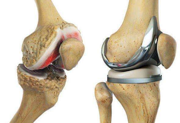 Outstanding Growth in Total Knee Replacement Market 2019