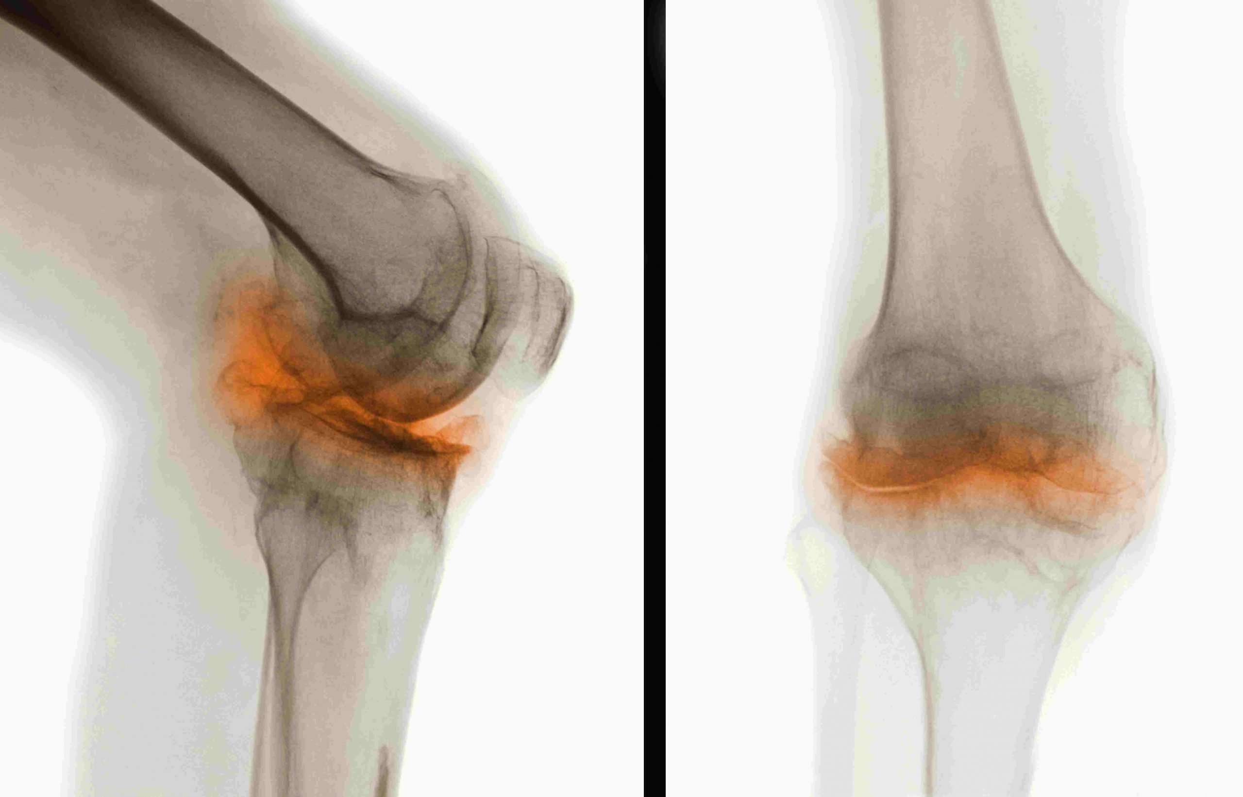 Overview of Osteoarthritis With Pictures