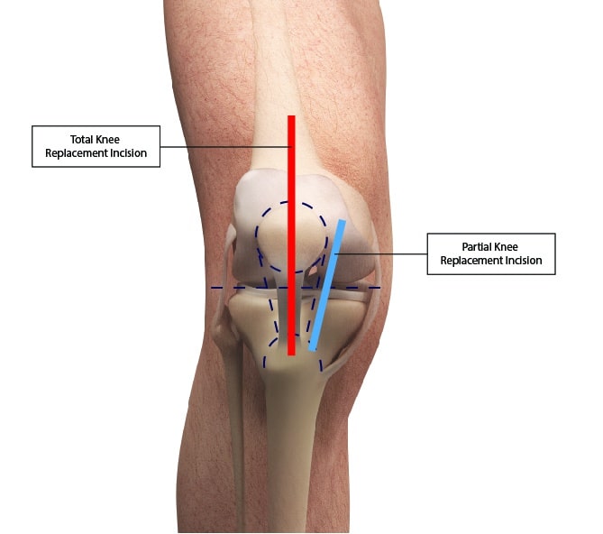 Oxford Partial Knee Replacement: An Alternative to Total Knee ...