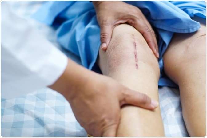 Pain After Knee Replacement Surgery