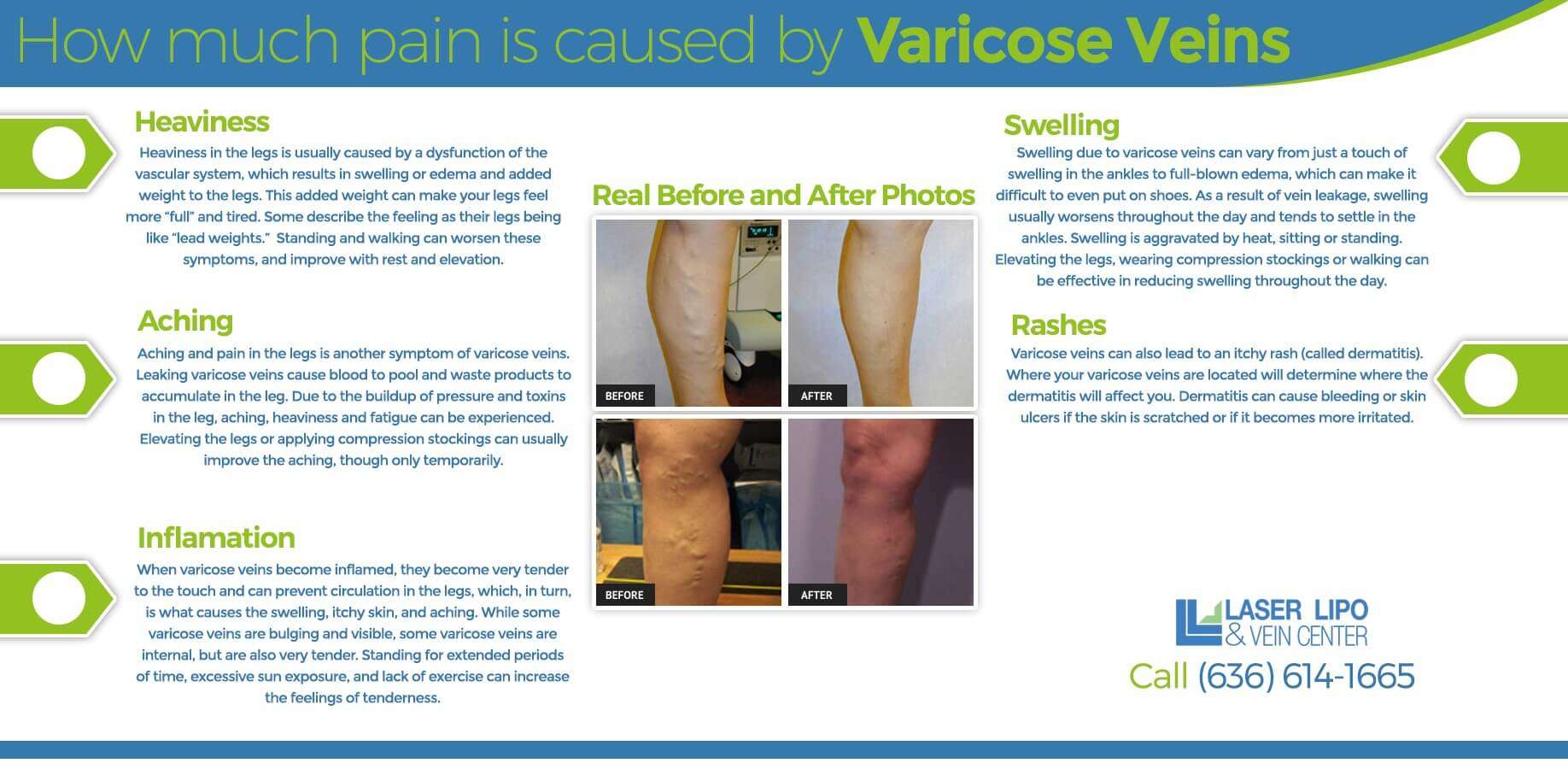 Pain of Varicose Veins Overview